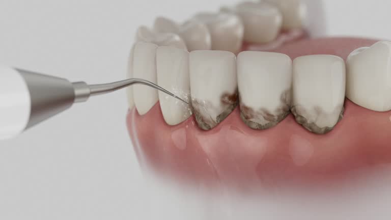 Trusted Wisdom Tooth Removal service in Kingsville, MD - Dentist Open Now